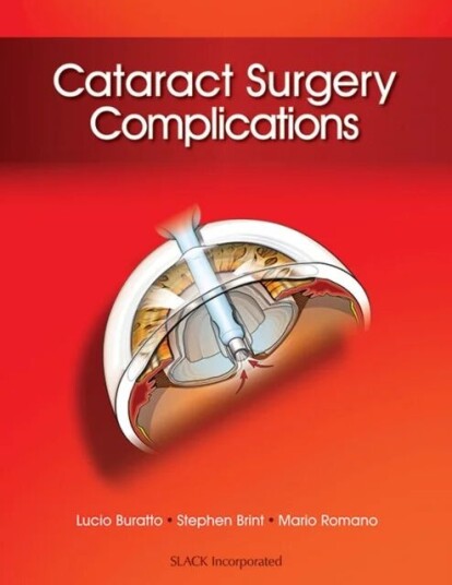 Cataract Surgery Complications Av Lucio Buratto, Stephen F. Brint, Mario R. Romano
