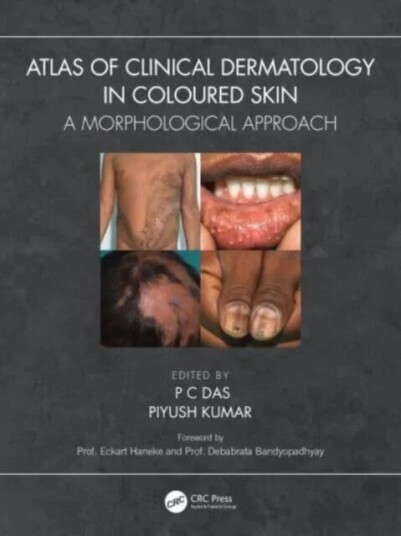 Atlas Of Clinical Dermatology In Coloured Skin