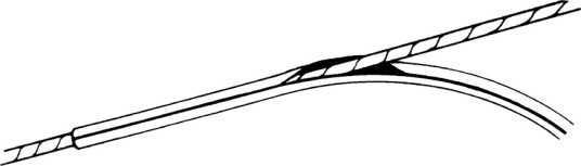Vanthylse   5 mm