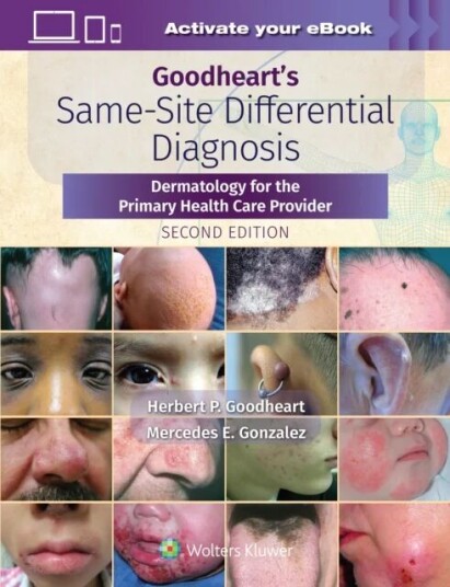 Goodheart'S Same-Site Differential Diagnosis Av Herbert Goodheart