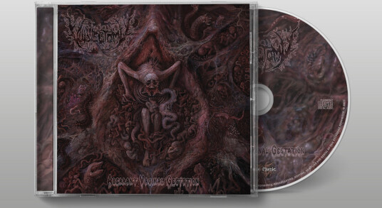 Vulvectomy Aberrant Vaginal Gestation CD