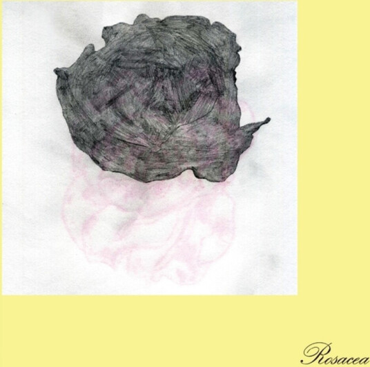 Rosacea