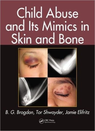 Child Abuse And Its Mimics In Skin And Bone Av B. G. Brogdon, Tor Shwayder, Jamie Elifritz