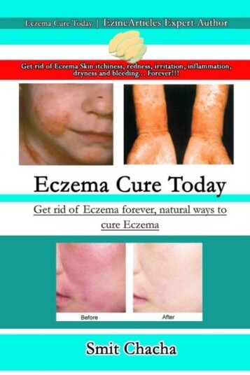 Eczema Cure Today   Get rid of Eczema forever natural ways to cure Eczema