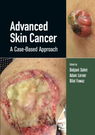 Advanced Skin Cancer