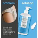 Salicylic Acid Keratosis Lotion 500 ml