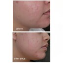 Anua Azelaic Acid 10% Hyaluron Beroligende Ansiktsserum 30 ML