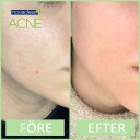 Novaclear Acne Kit Facial Foam Toner Cream